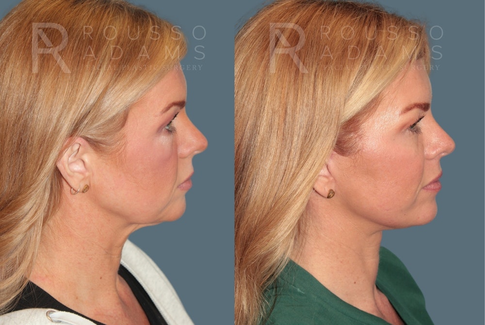 Deep Plane Facelift <span class=small>By Dr. Daniel Rousso</span> Before & After Gallery - Patient 278334 - Image 1