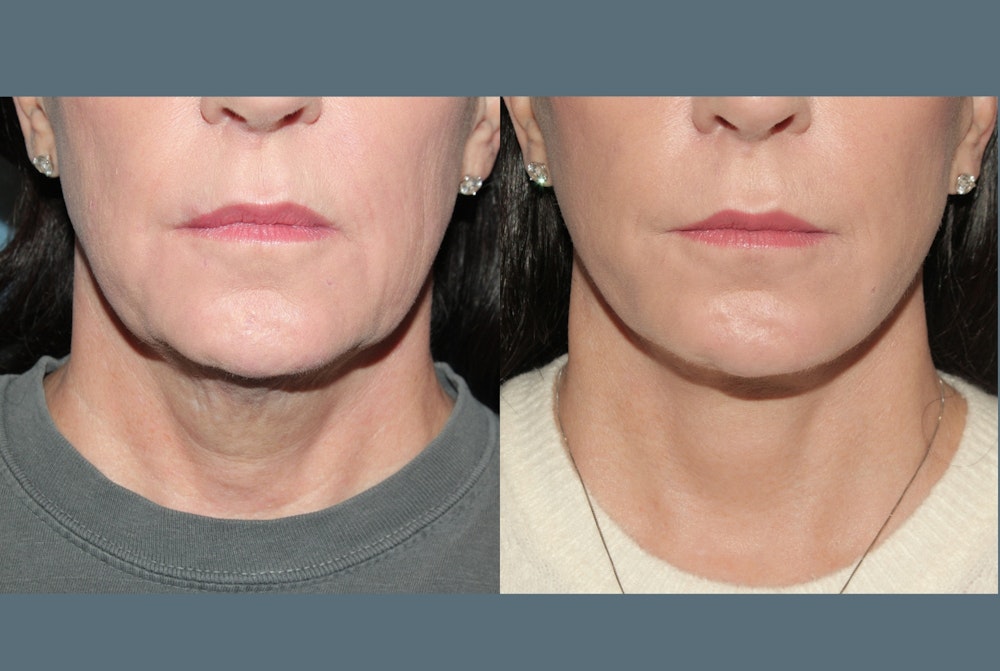 Deep Plane Facelift <span class=small>By Dr. Daniel Rousso</span> Before & After Gallery - Patient 423523 - Image 4