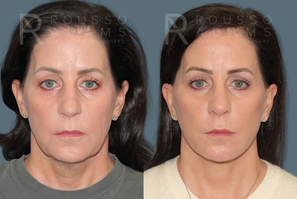 Deep Plane Facelift <span class=small>By Dr. Daniel Rousso</span> Before & After Gallery - Patient 423523 - Image 2