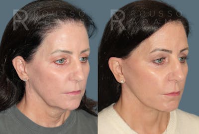 Deep Plane Facelift <span class=small>By Dr. Daniel Rousso</span> Before & After Gallery - Patient 423523 - Image 1