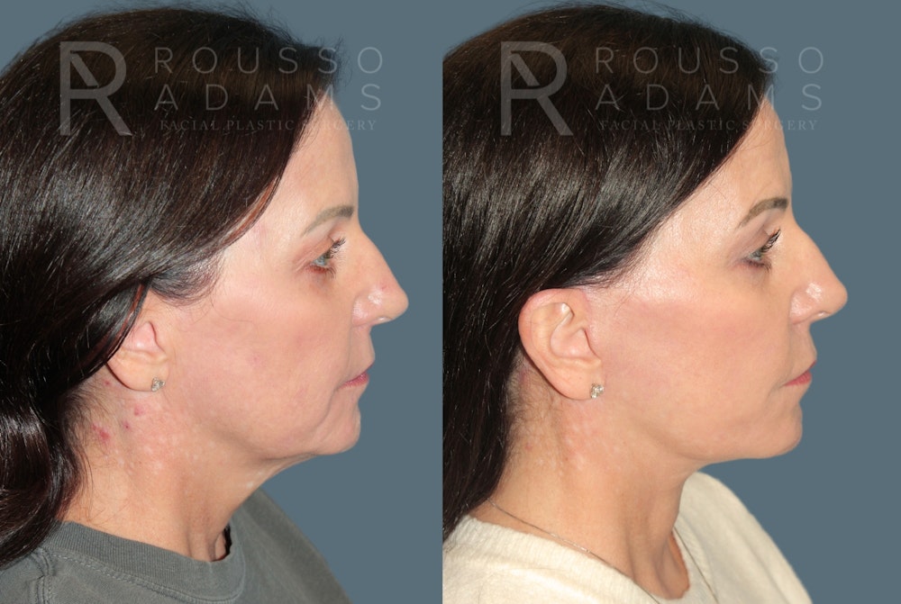 Deep Plane Facelift <span class=small>By Dr. Daniel Rousso</span> Before & After Gallery - Patient 423523 - Image 3