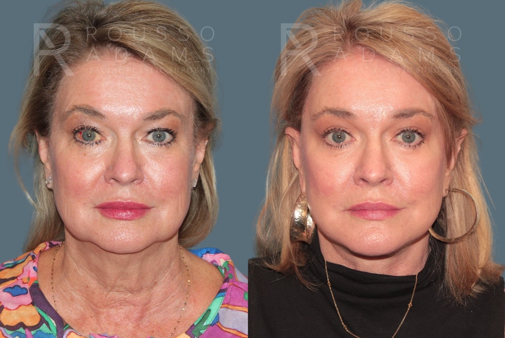 Deep Plane Facelift <span class=small>By Dr. Daniel Rousso</span> Before & After Gallery - Patient 105926 - Image 2