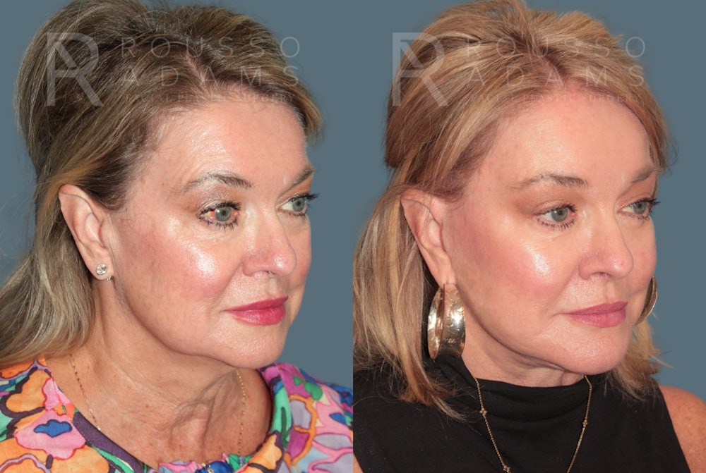Deep Plane Facelift <span class=small>By Dr. Daniel Rousso</span> Before & After Gallery - Patient 105926 - Image 1