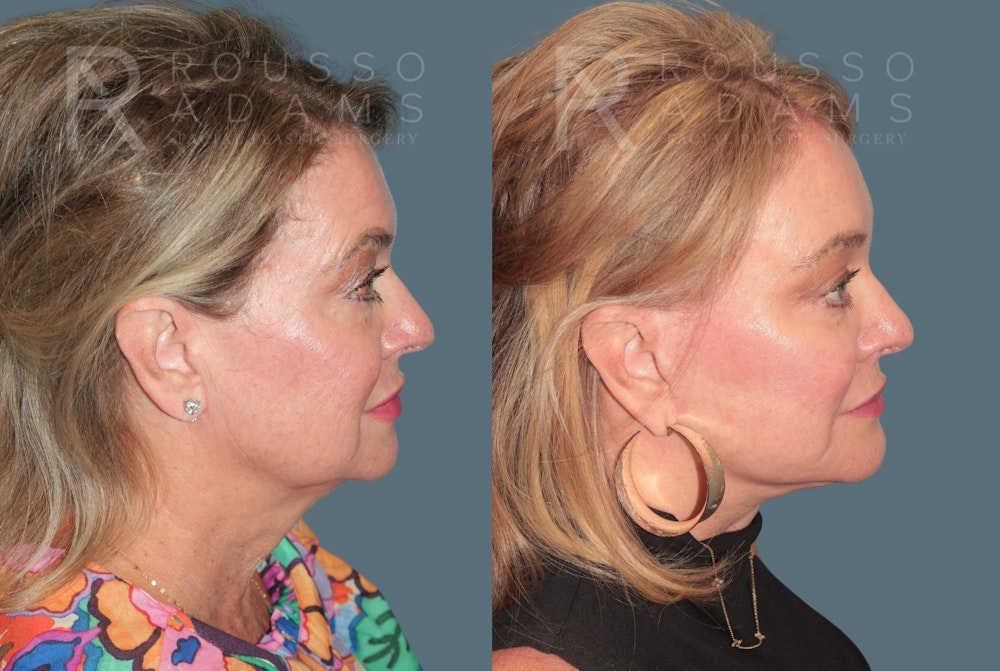 Deep Plane Facelift <span class=small>By Dr. Daniel Rousso</span> Before & After Gallery - Patient 105926 - Image 3