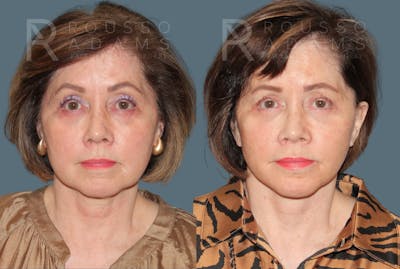 Deep Plane Facelift <span class=small>By Dr. Daniel Rousso</span> Before & After Gallery - Patient 111786 - Image 2