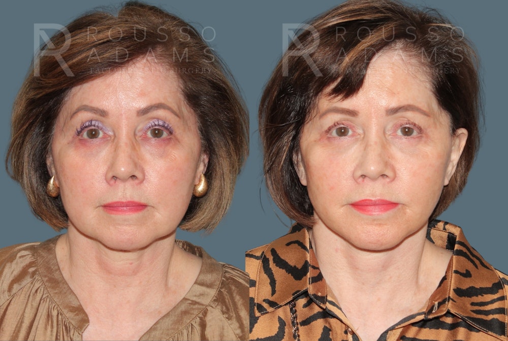 Deep Plane Facelift <span class=small>By Dr. Daniel Rousso</span> Before & After Gallery - Patient 111786 - Image 2