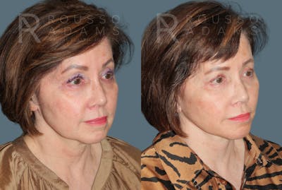 Deep Plane Facelift <span class=small>By Dr. Daniel Rousso</span> Before & After Gallery - Patient 111786 - Image 1