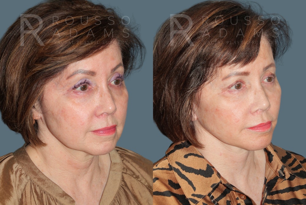 Deep Plane Facelift <span class=small>By Dr. Daniel Rousso</span> Before & After Gallery - Patient 111786 - Image 1