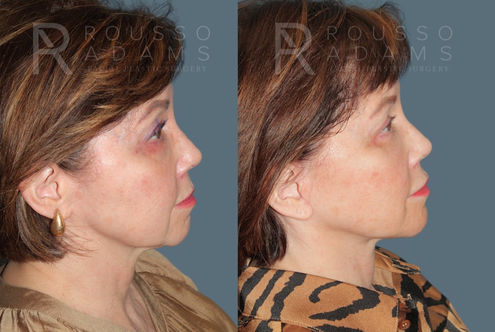 Deep Plane Facelift <span class=small>By Dr. Daniel Rousso</span> Before & After Gallery - Patient 111786 - Image 3