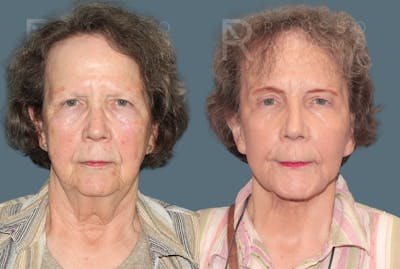 Deep Plane Facelift <span class=small>By Dr. Daniel Rousso</span> Before & After Gallery - Patient 180995 - Image 2