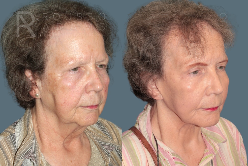 Deep Plane Facelift <span class=small>By Dr. Daniel Rousso</span> Before & After Gallery - Patient 180995 - Image 1