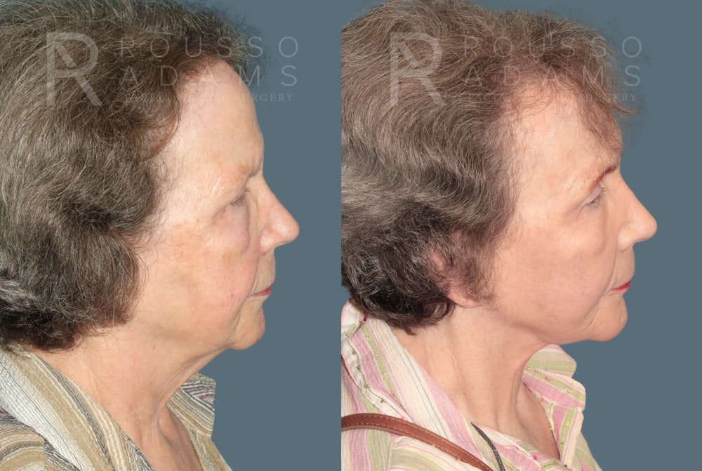 Deep Plane Facelift <span class=small>By Dr. Daniel Rousso</span> Before & After Gallery - Patient 180995 - Image 3