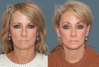 Deep Plane Facelift <span class=small>By Dr. Daniel Rousso</span> Before & After Gallery - Patient 220592 - Image 2