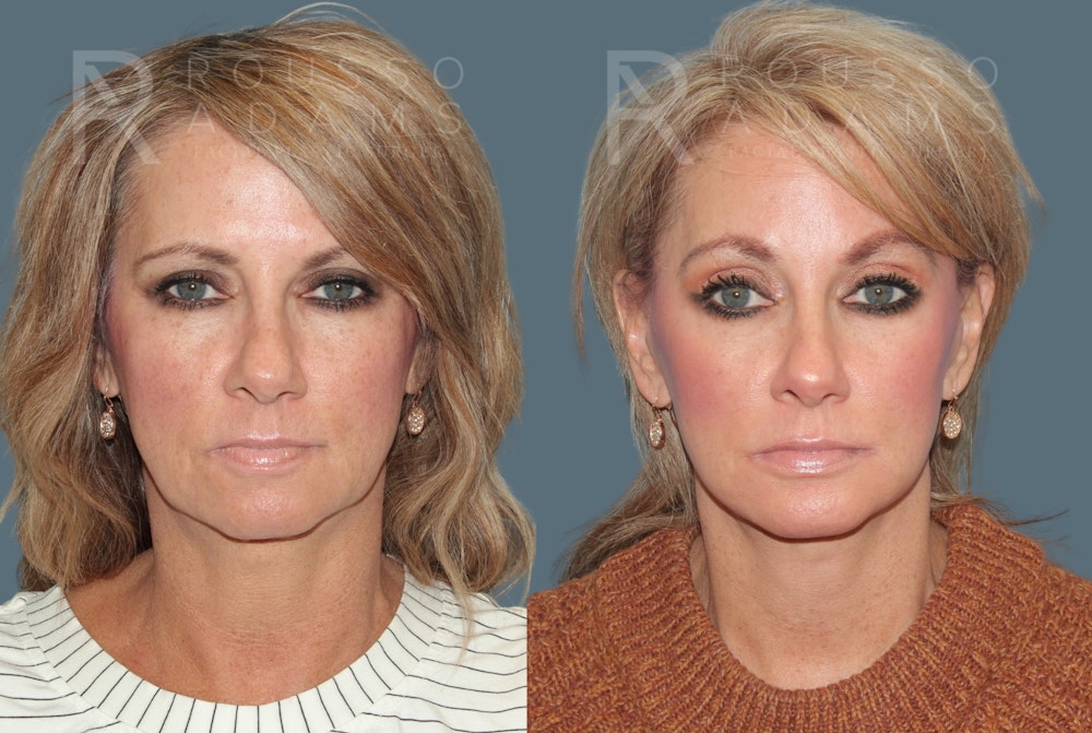 Deep Plane Facelift <span class=small>By Dr. Daniel Rousso</span> Before & After Gallery - Patient 220592 - Image 2