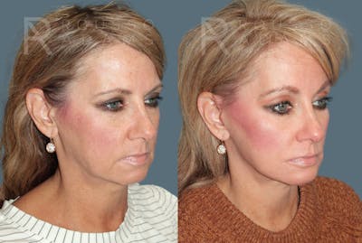 Deep Plane Facelift <span class=small>By Dr. Daniel Rousso</span> Before & After Gallery - Patient 220592 - Image 1