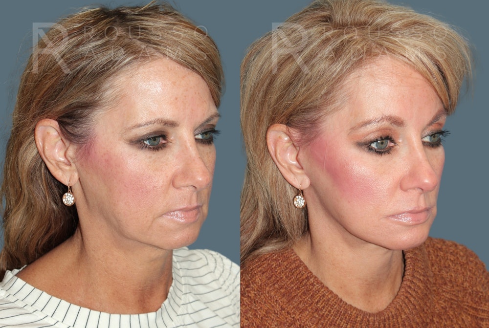 Deep Plane Facelift <span class=small>By Dr. Daniel Rousso</span> Before & After Gallery - Patient 220592 - Image 1
