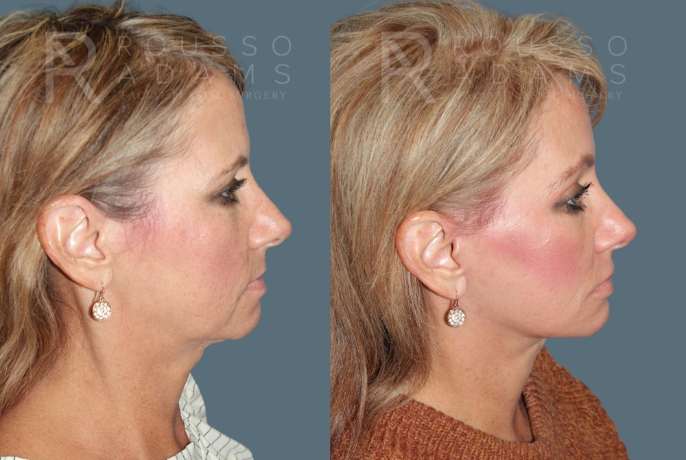 Deep Plane Facelift <span class=small>By Dr. Daniel Rousso</span> Before & After Gallery - Patient 220592 - Image 3