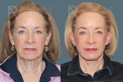 Deep Plane Facelift <span class=small>By Dr. Daniel Rousso</span> Before & After Gallery - Patient 107714 - Image 2