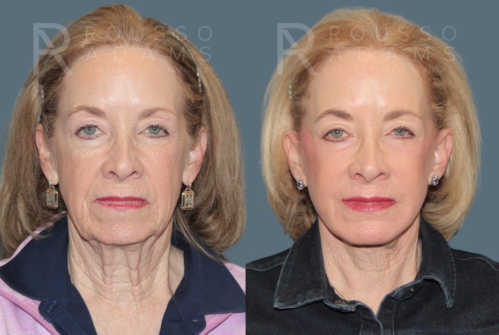 Deep Plane Facelift <span class=small>By Dr. Daniel Rousso</span> Before & After Gallery - Patient 107714 - Image 2