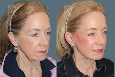 Deep Plane Facelift <span class=small>By Dr. Daniel Rousso</span> Before & After Gallery - Patient 107714 - Image 1