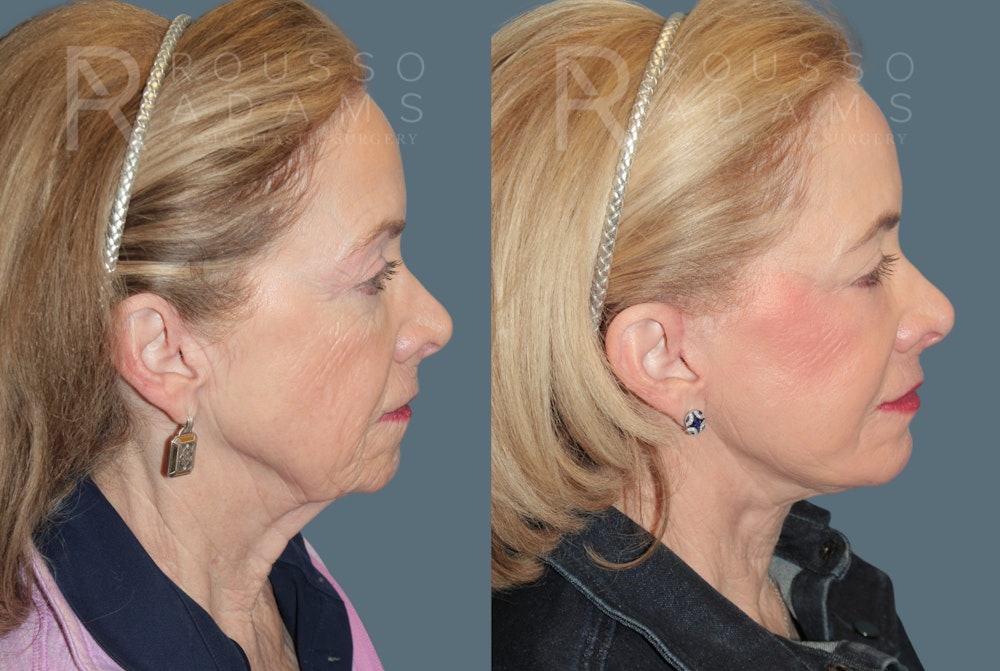 Deep Plane Facelift <span class=small>By Dr. Daniel Rousso</span> Before & After Gallery - Patient 107714 - Image 3