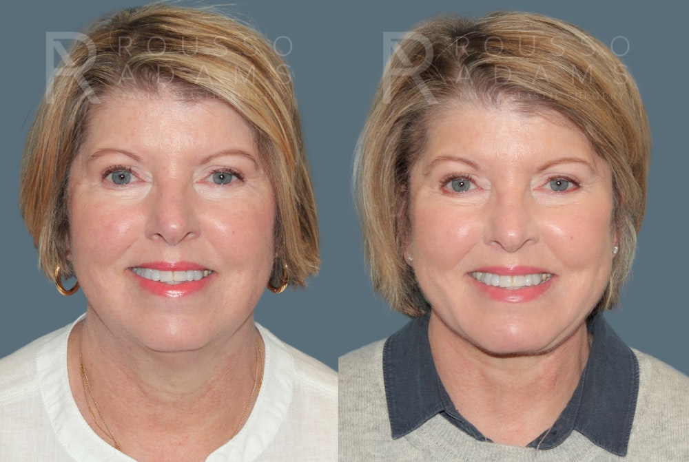 Deep Plane Facelift <span class=small>By Dr. Daniel Rousso</span> Before & After Gallery - Patient 283043 - Image 2