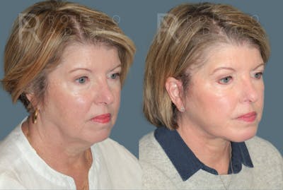 Deep Plane Facelift <span class=small>By Dr. Daniel Rousso</span> Before & After Gallery - Patient 283043 - Image 1