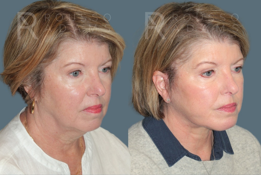 Deep Plane Facelift <span class=small>By Dr. Daniel Rousso</span> Before & After Gallery - Patient 283043 - Image 1