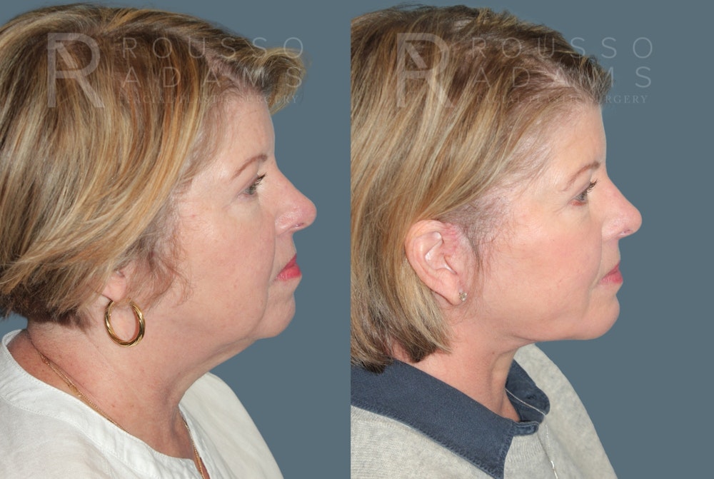 Deep Plane Facelift <span class=small>By Dr. Daniel Rousso</span> Before & After Gallery - Patient 283043 - Image 3