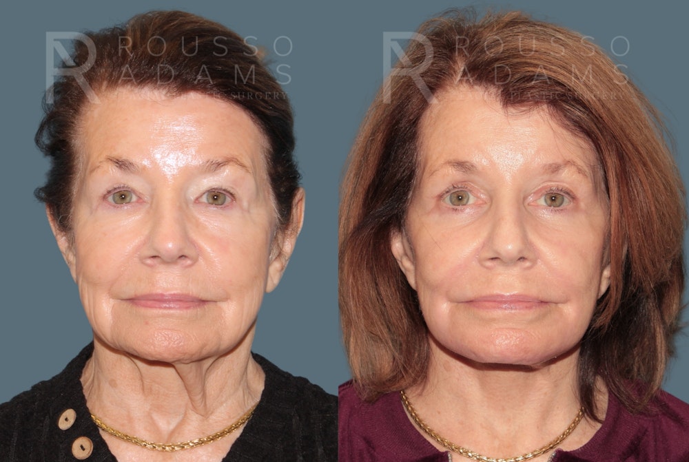 Deep Plane Facelift <span class=small>By Dr. Daniel Rousso</span> Before & After Gallery - Patient 416553 - Image 2
