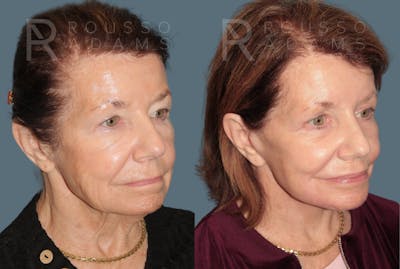 Deep Plane Facelift <span class=small>By Dr. Daniel Rousso</span> Before & After Gallery - Patient 416553 - Image 1