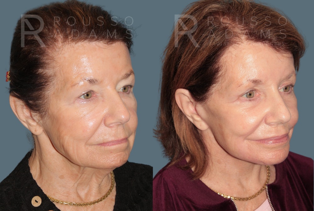 Deep Plane Facelift <span class=small>By Dr. Daniel Rousso</span> Before & After Gallery - Patient 416553 - Image 1