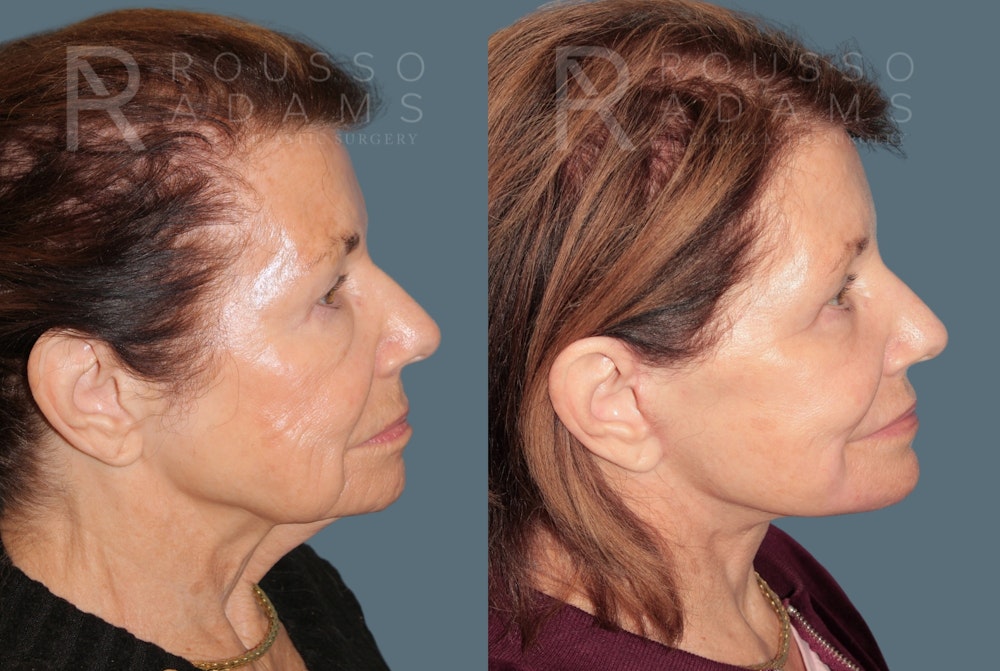 Deep Plane Facelift <span class=small>By Dr. Daniel Rousso</span> Before & After Gallery - Patient 416553 - Image 3