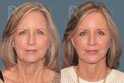 Deep Plane Facelift <span class=small>By Dr. Daniel Rousso</span> Before & After Gallery - Patient 978706 - Image 2