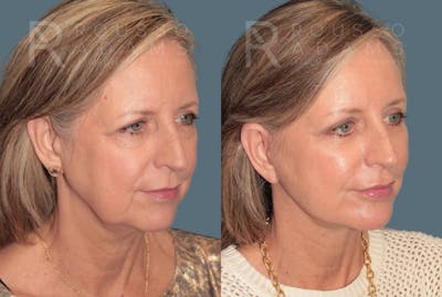 Deep Plane Facelift <span class=small>By Dr. Daniel Rousso</span> Before & After Gallery - Patient 978706 - Image 1