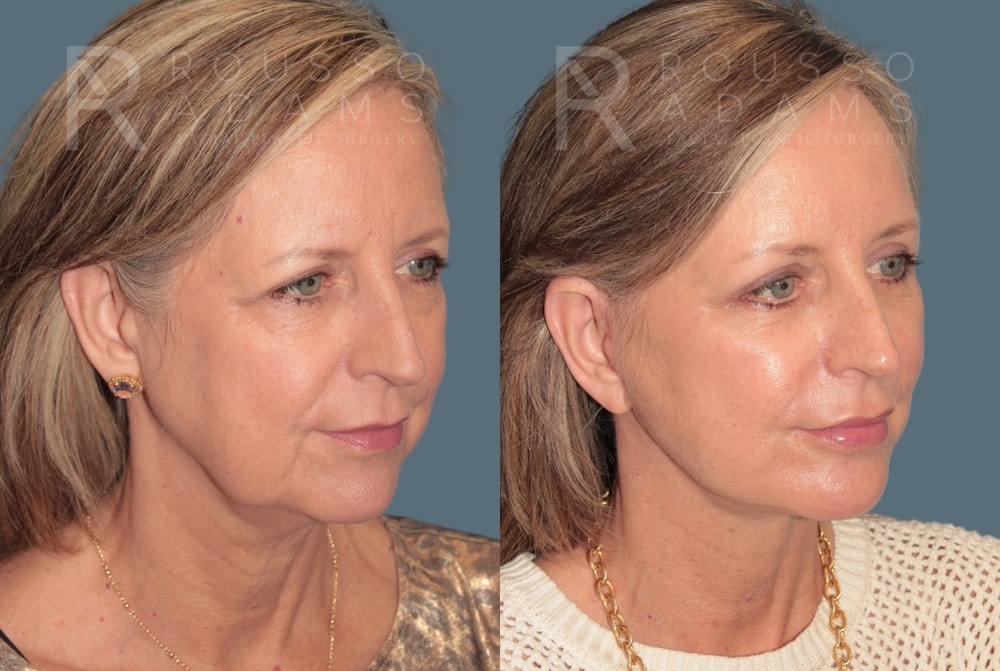 Deep Plane Facelift <span class=small>By Dr. Daniel Rousso</span> Before & After Gallery - Patient 978706 - Image 1