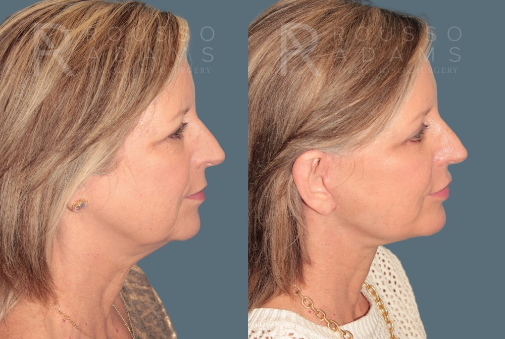 Deep Plane Facelift <span class=small>By Dr. Daniel Rousso</span> Before & After Gallery - Patient 978706 - Image 3