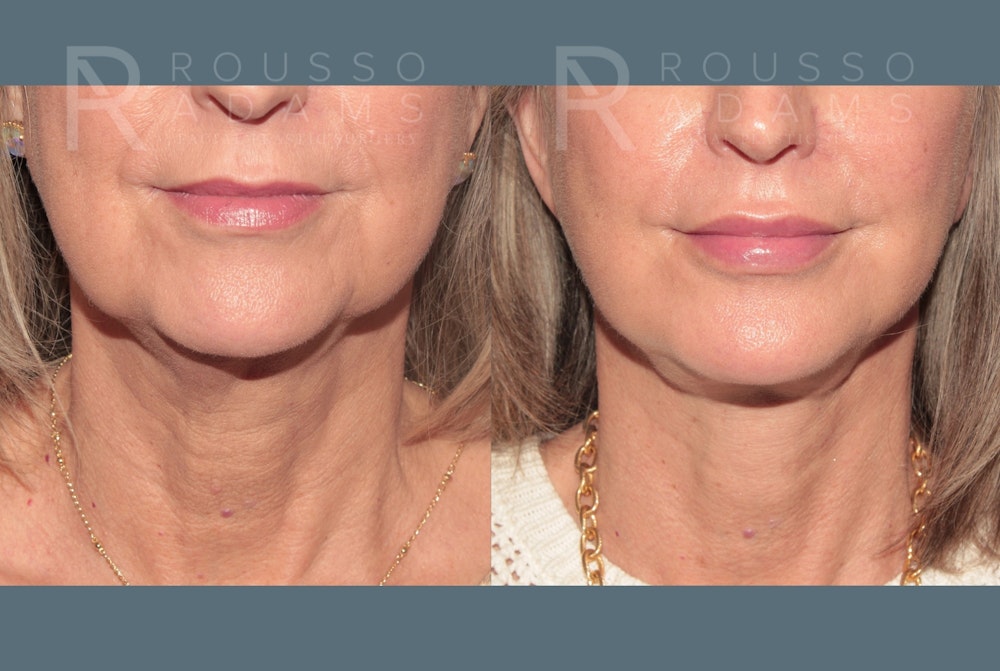 Deep Plane Facelift <span class=small>By Dr. Daniel Rousso</span> Before & After Gallery - Patient 978706 - Image 4