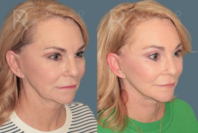 Deep Plane Facelift <span class=small>By Dr. Daniel Rousso</span> Before & After Gallery - Patient 780298 - Image 1