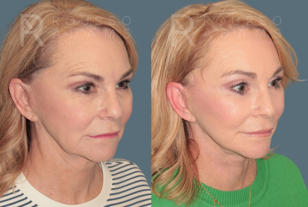 Deep Plane Facelift <span class=small>By Dr. Daniel Rousso</span> Before & After Gallery - Patient 780298 - Image 1