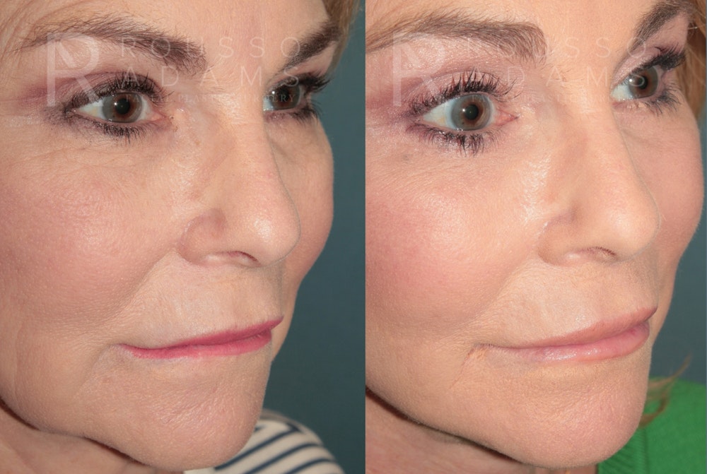 Deep Plane Facelift <span class=small>By Dr. Daniel Rousso</span> Before & After Gallery - Patient 780298 - Image 5