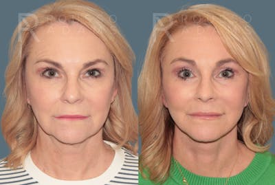 Deep Plane Facelift <span class=small>By Dr. Daniel Rousso</span> Before & After Gallery - Patient 780298 - Image 2