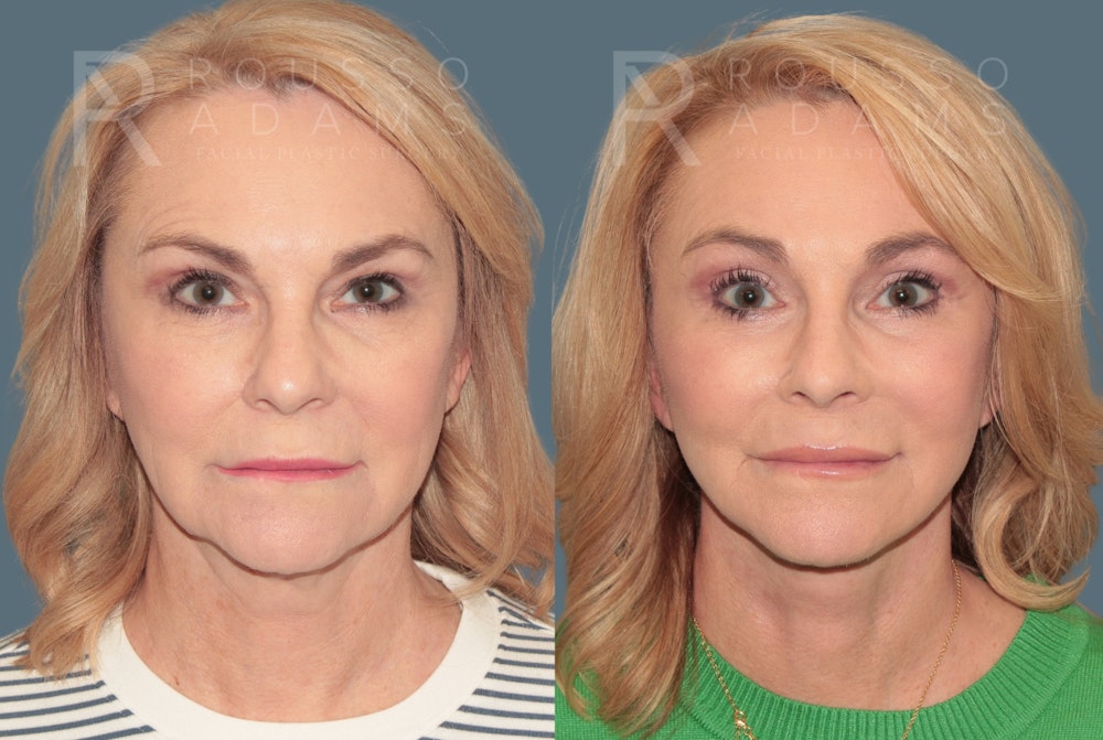 Deep Plane Facelift <span class=small>By Dr. Daniel Rousso</span> Before & After Gallery - Patient 780298 - Image 2