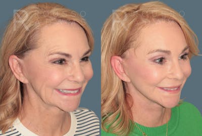 Deep Plane Facelift <span class=small>By Dr. Daniel Rousso</span> Before & After Gallery - Patient 780298 - Image 4