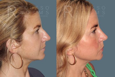 Rhinoplasty <span class=small>By Dr. Daniel Rousso</span> Before & After Gallery - Patient 138469 - Image 1
