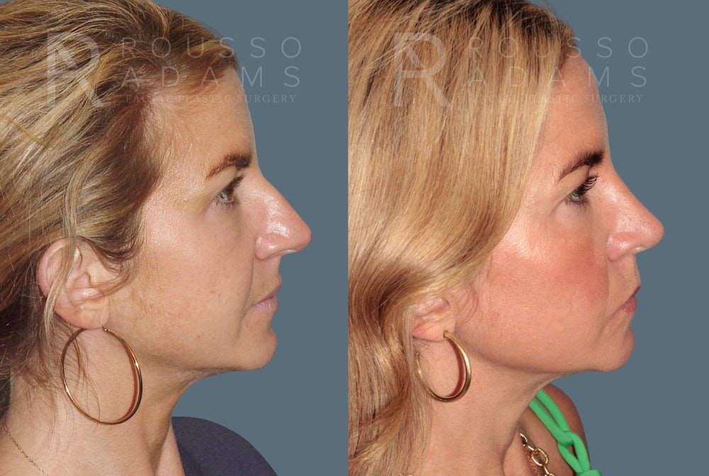 Rhinoplasty <span class=small>By Dr. Daniel Rousso</span> Before & After Gallery - Patient 138469 - Image 1