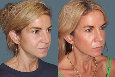 Rhinoplasty <span class=small>By Dr. Daniel Rousso</span> Before & After Gallery - Patient 138469 - Image 2