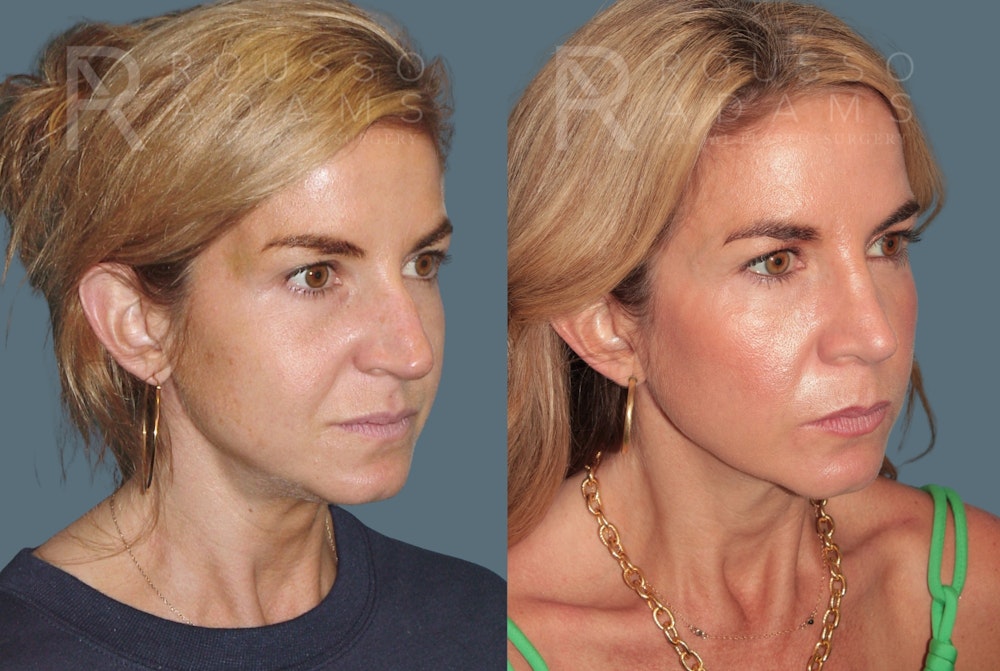 Rhinoplasty <span class=small>By Dr. Daniel Rousso</span> Before & After Gallery - Patient 138469 - Image 2
