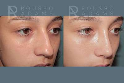 Rhinoplasty <span class=small>By Dr. Daniel Rousso</span> Before & After Gallery - Patient 158946 - Image 4
