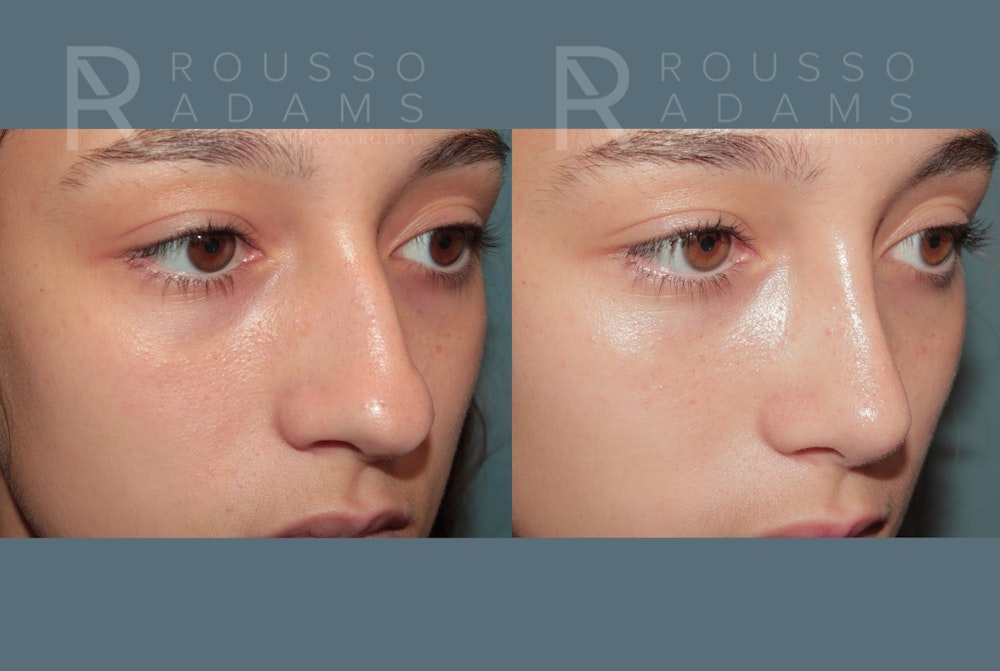 Rhinoplasty <span class=small>By Dr. Daniel Rousso</span> Before & After Gallery - Patient 158946 - Image 4